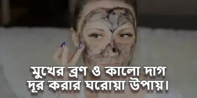 মুখের ব্রণ ও কালো দাগ দূর করার ঘরোয়া প্রাকৃতিক উপায়।